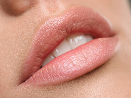 LipFix: Filler